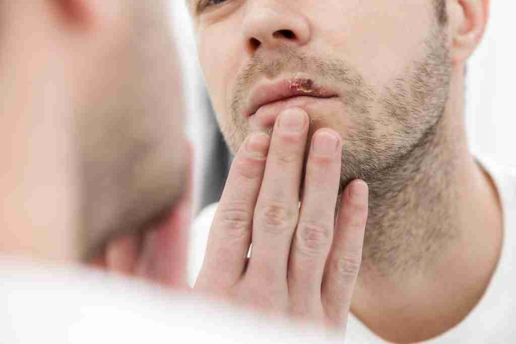 Man With Coldsore